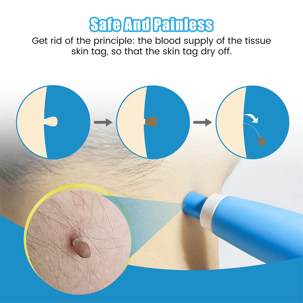 2 en 1 Micro Micro Skin Tag Dispositif Dispositif standard et micro-étiquette de peau Kit d'élimination de la peau