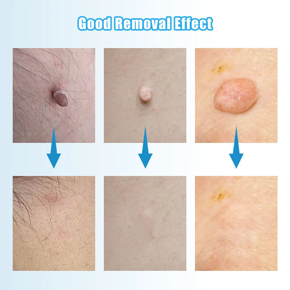 2 en 1 Micro Micro Skin Tag Dispositif Dispositif standard et micro-étiquette de peau Kit d'élimination de la peau